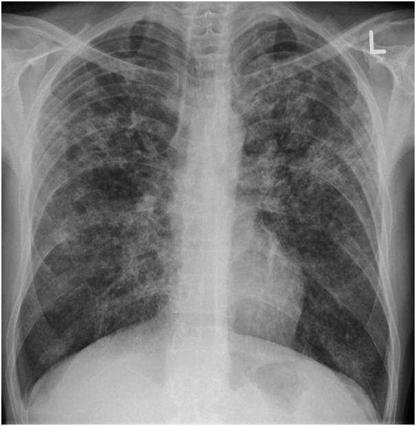 TB lung image